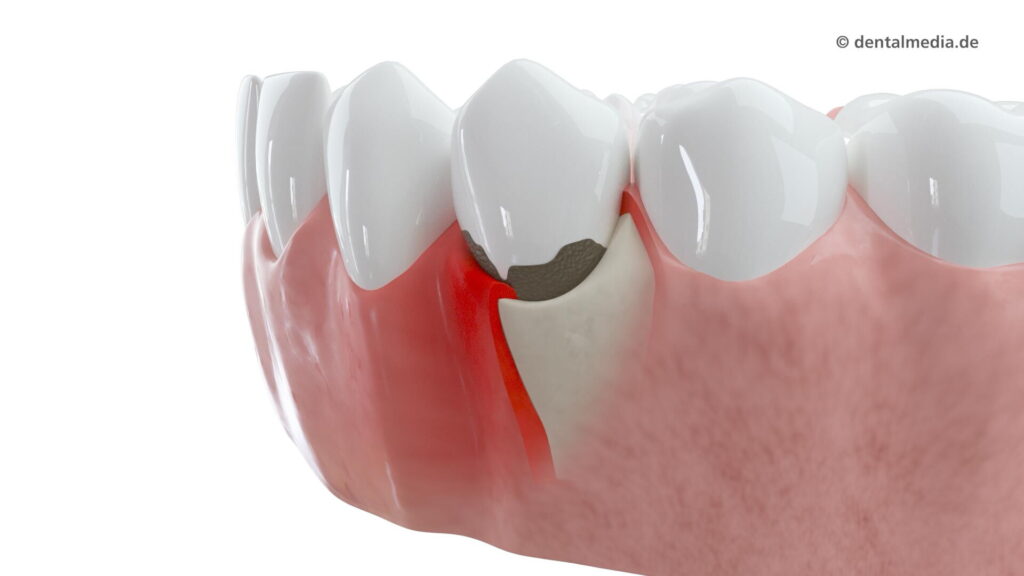 Parodontologie bei Ihrem Zahnarzt in Essen-Steele — Nils Friedrich